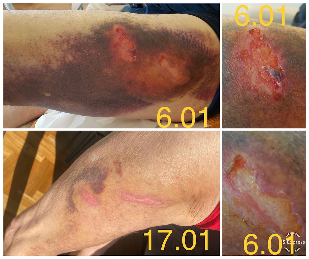 traumatism coapsa hematom plaga pierdere de substanta tratament domiciliu