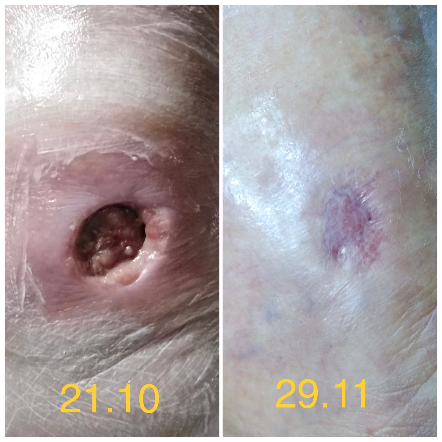 ulcer de gamba tratament la domiciliu evolutie vindecare rana cronica