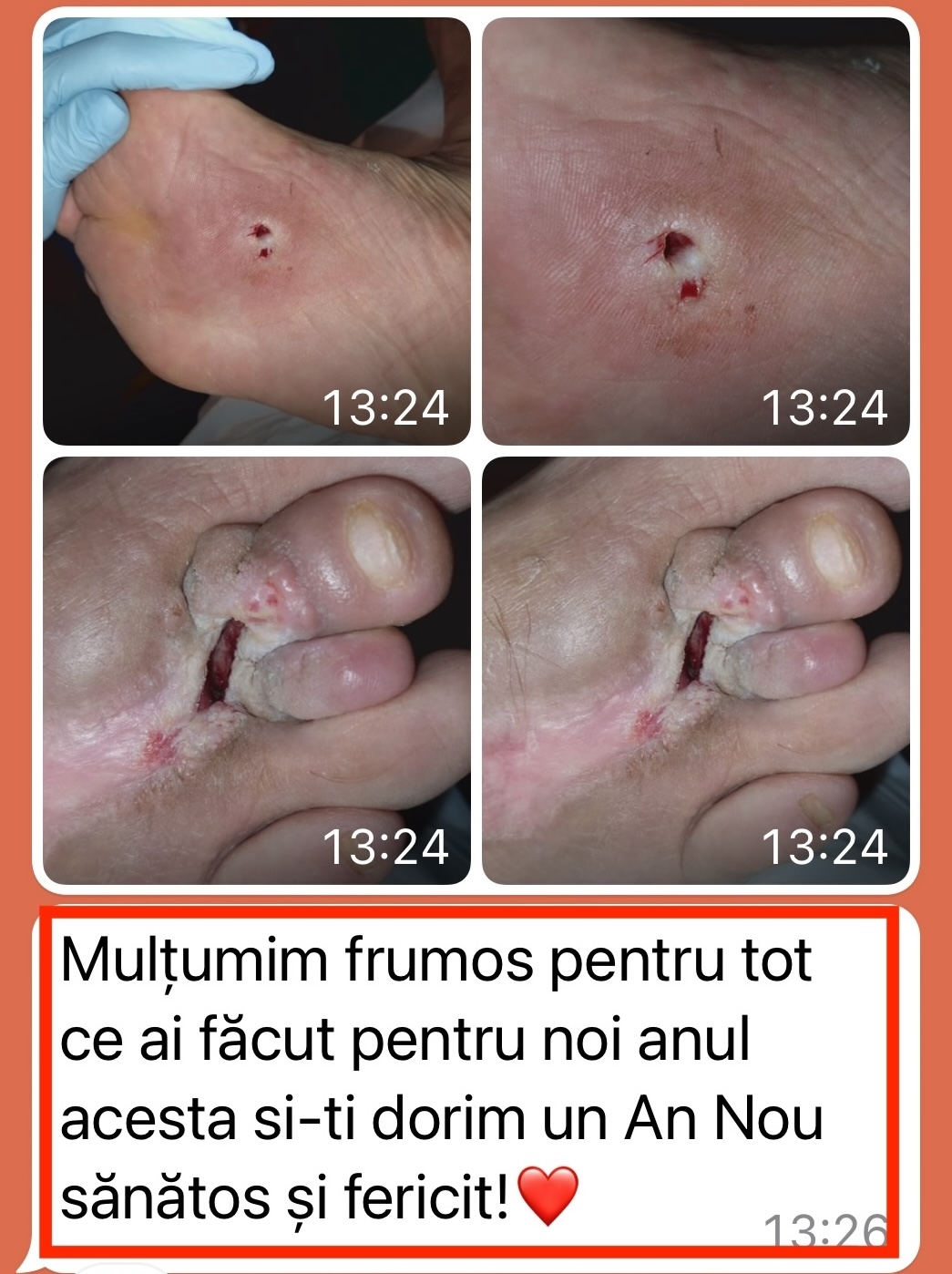 vindecarea progresivă a unei plăgi la picior după aplicarea tratamentului corect.