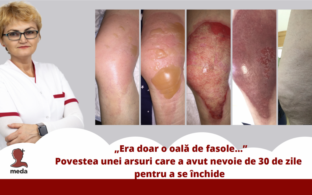 opărire cu lichide fierbinți tratament corect arsura