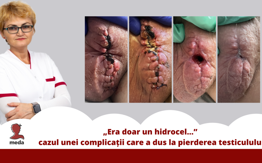„Era doar un hidrocel … ” cazul unei complicații care a dus la pierderea unui testicol