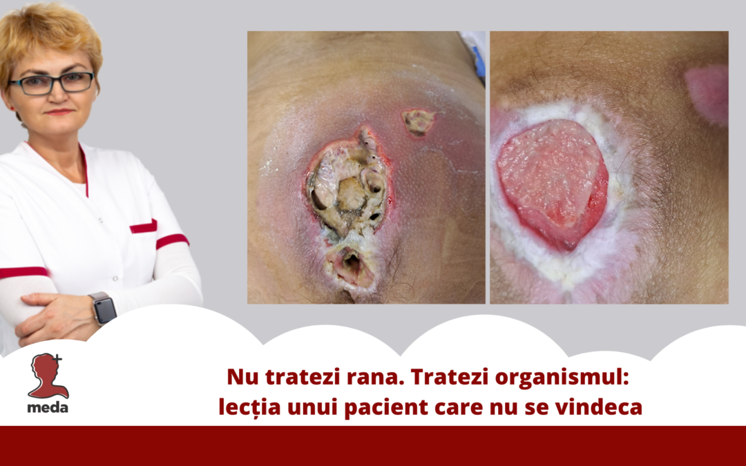 evolutie rana cronica infectata si vindecare pacient